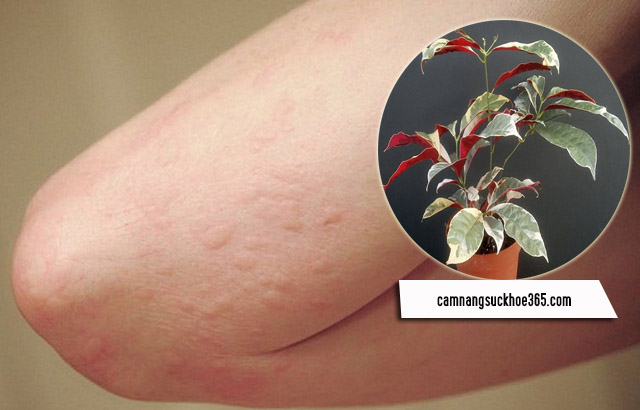 Cách chữa bệnh mề đay bằng lá đơn đỏ