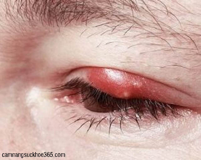 bị ngứa khóe mắt do đâu? Biểu hiện bệnh gì?