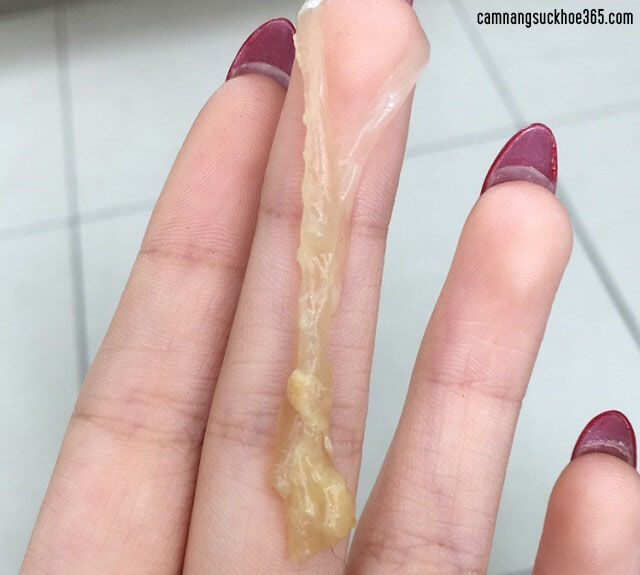 Ra nhiều huyết trắng là dấu hiệu của bệnh lý
