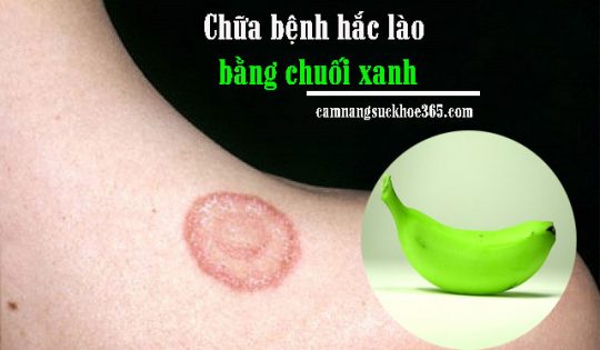 Chữa bệnh hắc lào bằng chuối xanh