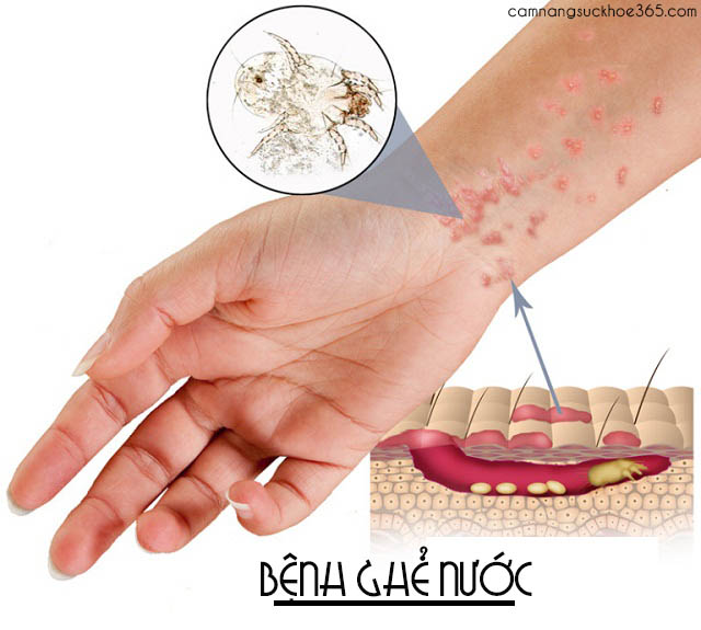Chữa ghẻ nước bằng lá cây quanh vườn