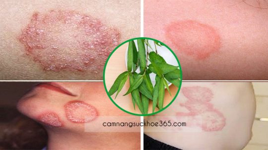 Cách chữa bệnh hắc lào bằng rau răm