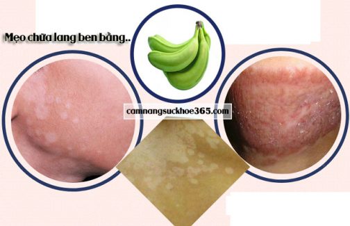Chữa lang ben bằng chuối xanh
