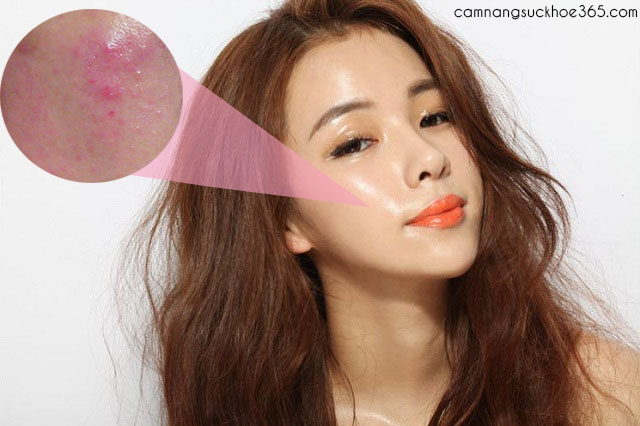 Mẹo chữa viêm da dầu ở mặt ngay tại nhà