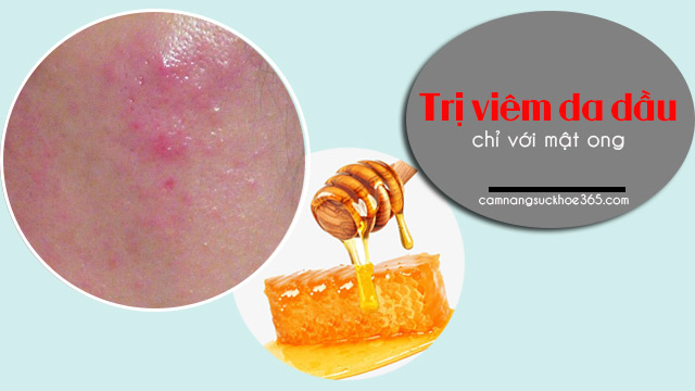 Mẹo chữa viêm da dầu ở mặt ngay tại nhà