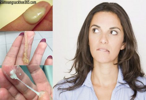 Ra nhiều huyết trắng là dấu hiệu của bệnh lý