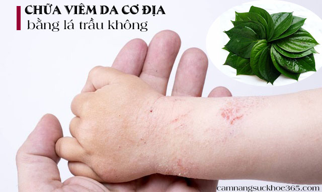 Chữa viêm da cơ địa bằng lá trầu không