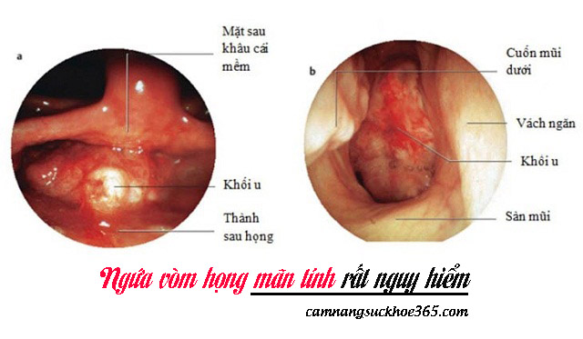 Thường xuyên bị ngứa vòm họng là bệnh gì? Điều trị như thế nào?