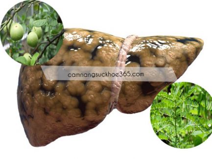 Tự chữa bệnh gan nhiễm mỡ bằng thuốc nam