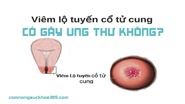 Viêm lộ tuyến cổ tử cung có gây bệnh ung thư? 