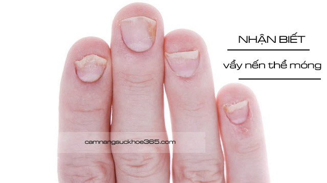 Các dấu hiệu nhận biết bệnh vẩy nến