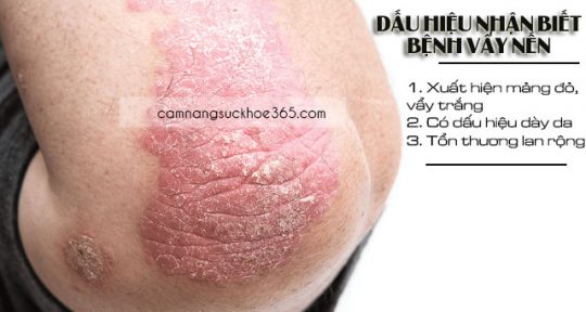 Các dấu hiệu nhận biết bệnh vẩy nến