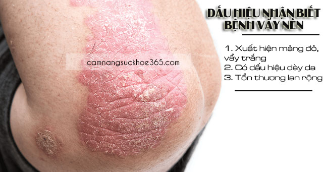 Các dấu hiệu nhận biết bệnh vẩy nến