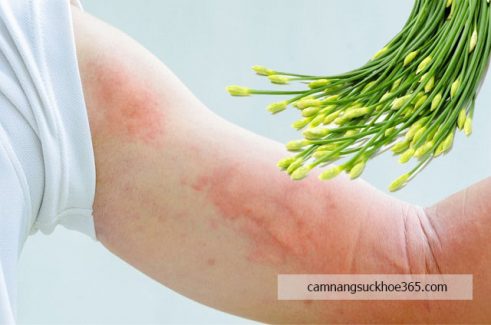 Khám phá cách trị mề đay từ lá hẹ