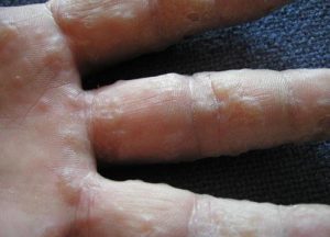 bệnh tổ đỉa