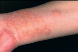 chữa mề đay bằng lá kinh giới