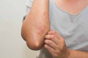 ngứa da do viêm da tiết bã
