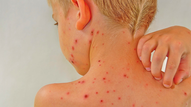nổi mẩn đỏ ngứa khắp người như muỗi đốt