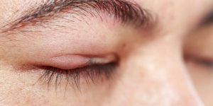 viêm bờ mi do viêm da tiết bã