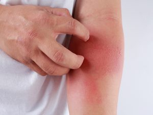 bác sĩ chữa viêm da cơ địa