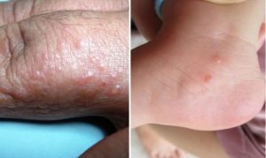 chữa bệnh tổ đỉa ở chân và tay 