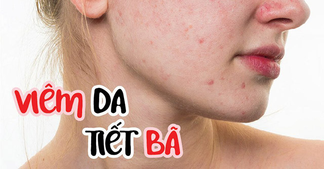 Bệnh viêm da tiết bã nhờn ở mặt là gì?
