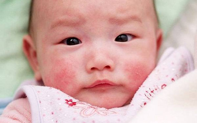 viêm da cơ địa ở trẻ sơ sinh