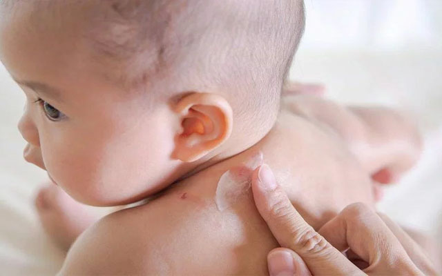 triệu chứng viêm da cơ địa ở trẻ sơ sinh