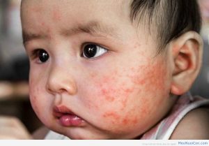 Triệu chứng của bệnh chàm sữa