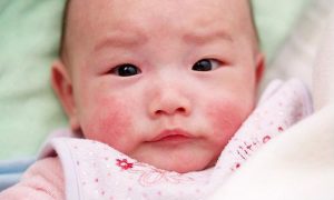chữa chàm sữa bằng sữa mẹ