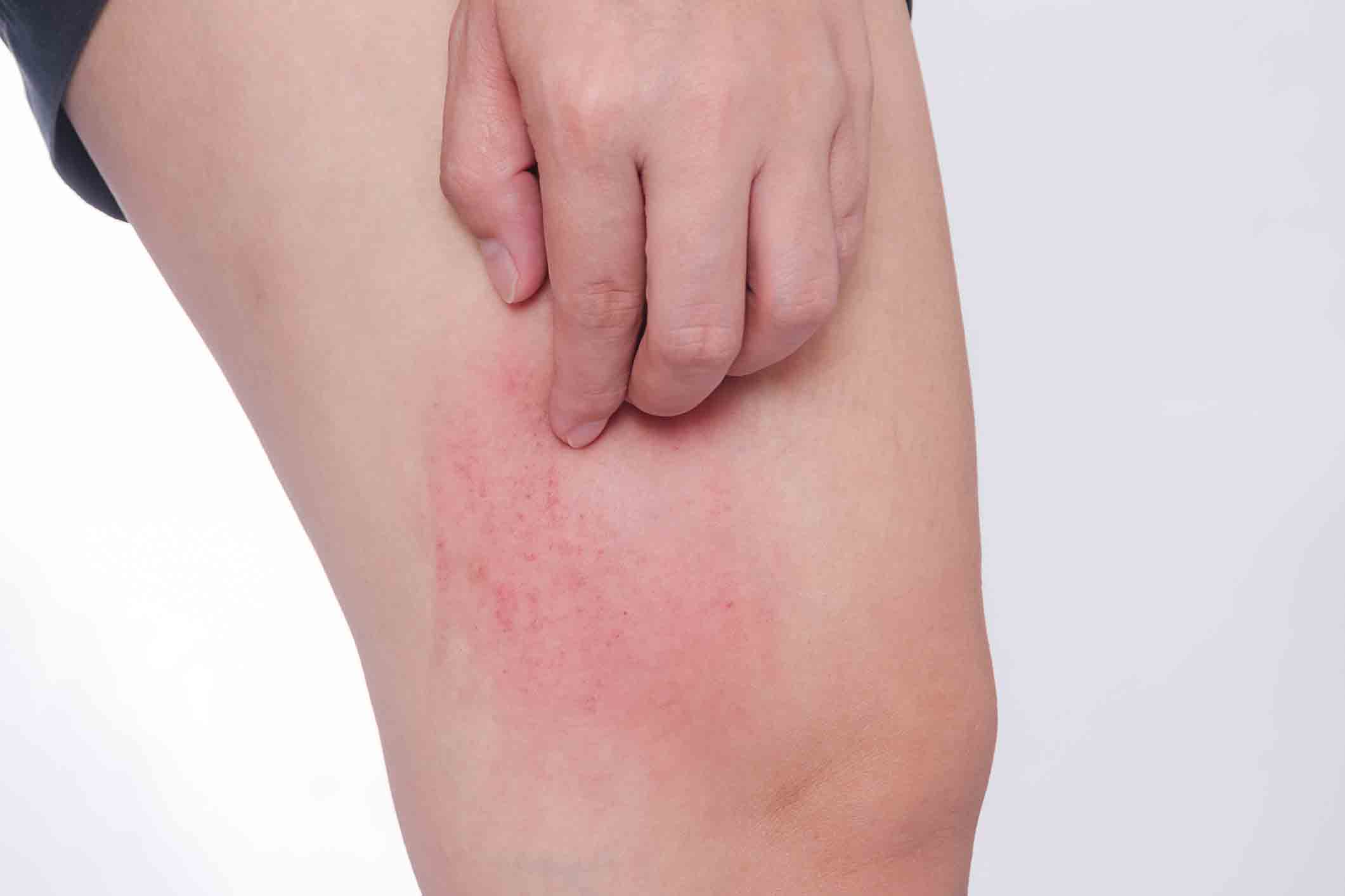 chế độ ăn khi nổi mề đay 
