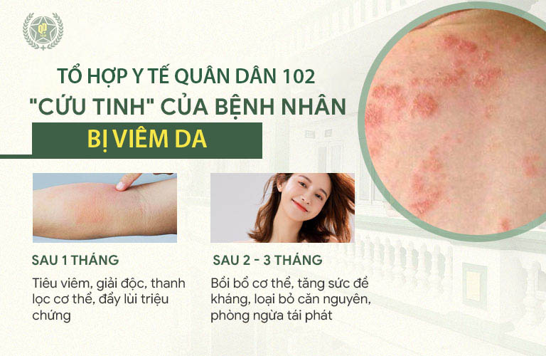 Kết quả điều trị viêm da tại Quân dân 102
