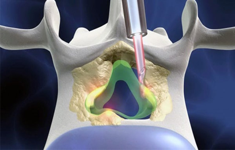 Mô phỏng phương pháp mổ thoát vị đĩa đệm bằng tia laser