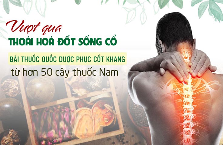 Bài thuốc Quốc dược Phục cốt khang đặc trị thoái hoá đốt sống cổ