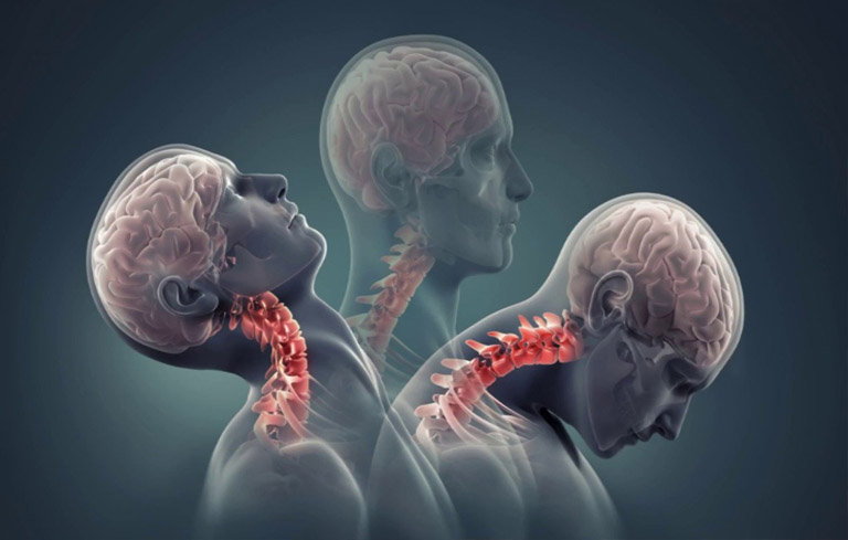 Thoái hóa đốt sống cổ uống thuốc gì là băn khoăn của nhiều người bệnh
