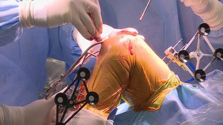 Thận trọng với những biến chứng khó lường sau phẫu thuật chữa thoái hóa khớp