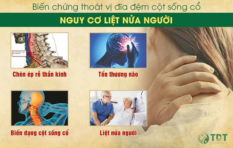 Thoát vị cột sống cổ có thể gây tổn thương não, liệt nữa người